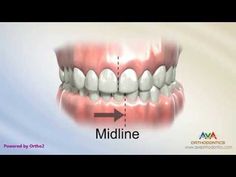 Orthodontic Treatment for Narrow Upper Jaw with Functional Shift - Expander or Spacer - YouTube Expanders For Teeth, Orthodontics Teeth, Mouth Health, Teeth Braces