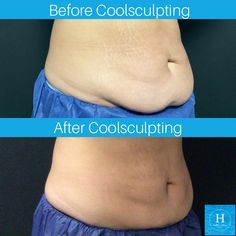 Coolsculpting before and after photo belly fat reduction Cryo Sculpting Before And After, Chin Lipo Before And After, Facial Lipo Before And After, Lipo Suction Before And After, Lipo 360 After Care, Body Change