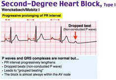 Second Degree Heart Block, Mobitz Type I (Wenckebach) P ... Cardiology Notes, Respiratory Therapist Student, Ekg Technician, Pr Interval, Medical Mnemonics