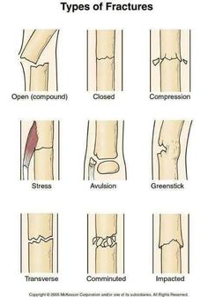 the different types of fractured bones and their corresponding structures are shown in this diagram, which shows