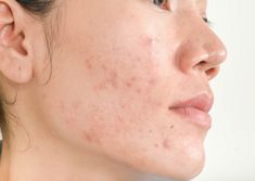 Mujer joven con acné, piel seca, piel de puntos negros en círculo de zoom. chica joven, retrato de belleza. de cerca. | Foto Premium Demodex Mites, Pimples Under The Skin, Diy Acne, Natural Acne Remedies, Types Of Acne, How To Get Rid Of Pimples, Acne Causes, Acne Remedies, Acne Marks