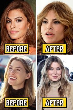 Celebrity Surgery, Cheek Implants, Plastic Surgery Fail, Plastic Surgery Gone Wrong, Face Surgery, Easy Care Hairstyles, Tattoos Men, Hair Mistakes