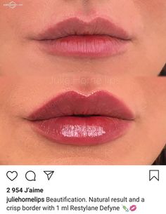 Best Celebrity Lips, Pdo Thread Lift, Lips Fillers, Lip Permanent Makeup, Lips Shape, Face Fillers