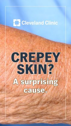 Crepy Skin, Crepe Skin, Creepy Skin, Crepey Skin, Saggy Skin, Cleveland Clinic, Summer Dresses For Wedding Guest, Skin Remedies