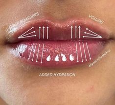 Lip Injection Techniques, Filler Lip, Skin And Hair Clinic