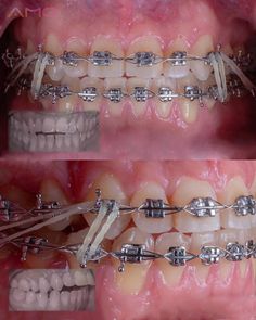 СООБЩЕСТВО ВРАЧЕЙ-ОРТОДОНТОВ🔝 on Instagram: “Автор @am.ortho Case in progress: started with massive overjet, an open bite, proclined upper incisors with class II molar and canine…” Ortodensi Teeth, Aesthetic Dental, Braces Colors, In Progress, July 1, Hair Highlights