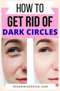 HOW TO GET RID OF DARK CIRCLES African Shea Butter Benefits, Dark Circle Removal, Natural Hacks, Natural Wrinkle Reducer, Under Eye Dark Circles, Dark Under Eye Circles, Eye Dark Circles, Shea Butter Benefits