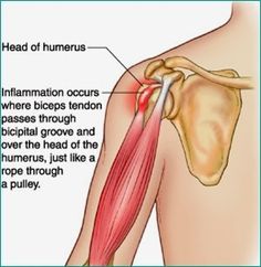 7 Common Reasons Why You Have Shoulder Pain Shoulder Impingement