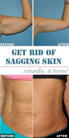 Remedies For Skin, For Skin Tightening, Home Remedies For Skin, Crepey Skin, Saggy Skin, Beauty Remedies, Skin Remedies, Trening Abs, Loose Skin