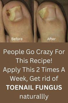 Infected Toenail, Toenail Health, Toenail Fungal Infection, Fingernail Fungus, Toenail Fungus Remedies, Nail Problems, Nail Fungus Remedy, Nail Infection, Fungal Nail