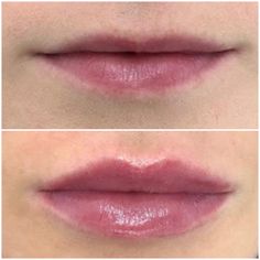 1ml Lip Filler, Im Worried, Juvederm Lips, Lips Inspiration, Botox Lips, Light Makeup Looks, Facial Contouring, Small Lips