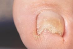 Ingrown Toenails ProMed Clinic Ingrown Toe Nail, Nails Acrylic, Toe Nails, Acrylic Nails, Nails