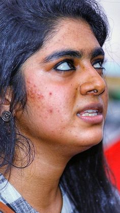 a woman with freckles on her face looking off to the side