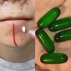 Vitamin E Serum, Work Problems, How To Remove Blackheads, Shiny Makeup, Chicken Pictures, To Remove Blackheads, Haunting Photos, Natural Skin Care Remedies, Clear Healthy Skin