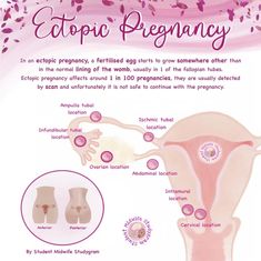 an info sheet describing the stages of uterineticticity