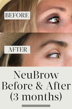 An honest review of the 8 best eyebrow growth serums according to customer reviews and brow experts, plus tips on how to decide which one's right for you. Eyebrow Growth Before And After, Eye Brow Growth, Brow Growth