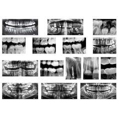 Learn the importance of taking care of your teeth! Good dental hygiene doesn't stop with the tooth brush. Our dental x-rays provide excellent examples of the benefits of good dental habits, and the consequences of bad habits. See for yourself the importance of wearing protective mouth gear when playing sports, and how Dental Xrays, Flossing Teeth, Tooth Chart, Loose Tooth, Dental Braces, Dental Bridge, X Rays, Dental Crowns, Tooth Brush