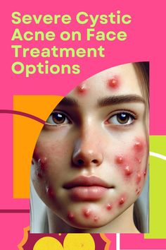 Severe Cystic Acne on Face: Effective Treatment Options Dermatologist Recommended Skincare, Extra Skin, Severe Acne, Clearer Skin, Scarring