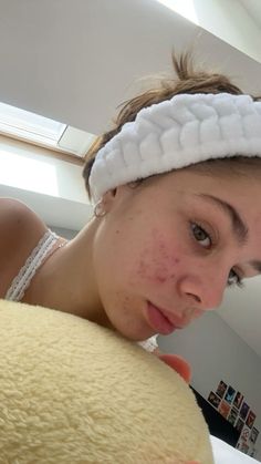 Pimple Marks, Health And Beauty, Acne, Human