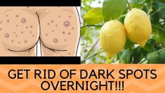 dark spots on the buttox can be a problem to alot of people and it affects people of all ages , it is one of the most avoided topic , because people that has... Dark Spots On Buttocks, Dark Buttocks, Dark Spots On Legs, Dark Spots Remedies, Spots On Legs, Dark Spots On Face, Remove Dark Spots, Oily Skin Care, Happy Skin