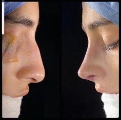 Select Your Nose Shape And Well Tell Pointy Nose, Pointed Nose, Nose Jobs, Rhinoplasty Nose Jobs, Facial Bones, Broken Nose, Job Inspiration, Straight Nose