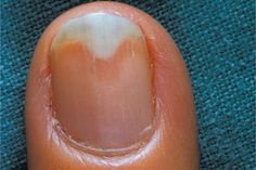 Nail Remedies, Fingernail Fungus, Nail Fungus Remedy, Fungal Nail, Nail Repair