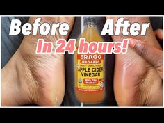 Dry Skin Feet Remove, How To Get Rid Of Dry Skin On Feet Heels, Dry Calloused Feet Remedy, How To Soften Feet Overnight, Dry Feet Remedies Overnight Diy, Dry Scaly Feet Remedies, How To Get Dry Skin Off Feet, Soft Heels Remedies, Peeling Feet Remedy Diy