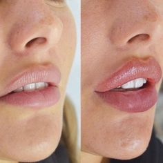 Cheek Fillers, Facial Fillers