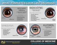 Here's What Your Eyes Look Like When You Take Different Drugs  The eyes can tell a lot about a person if he or she is under the influence of drugs or alcohol. Substances such as cocaine, alcohol, meth, and marijuana have different effects on the body.  These effects can be reflected in the eyes as well. Just by looking at a person’s eyes, you can get identify the affects on eye  #Drug #Eyes #doctorofmedicine #texila Drugged Eyes, Emt Study, Nurse Teaching, College Of Medicine, Droopy Eyes, Glossy Eyes, Medical School Essentials, How To Read People, Medicine Doctor