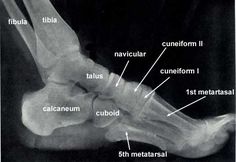 an x - ray view of the foot and ankle with labels on each side of it