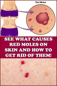 What Causes Red Moles on Skin  - and How to Get Rid of Them by Trevor Buckland | This newsletter was created with Smore, an online tool for creating beautiful newsletters for educators, businesses and more Red Moles On Skin, Cancerous Moles, Red Moles, Natural Remedies For Allergies, Skin Moles, Skin Bumps, Natural Headache Remedies, Skin Growths, Lose 40 Pounds