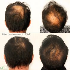 ⚡️These results are from one treatment of SVF. Use of stem cells and SVF to treat hair loss is the best non-invasive technique to unlock the power of your cells to grow hair.  ⁠ #microfue #fuehairtransplant #hairtransformation #hairtransplantUSA #hairtransplantboston #hairline #hairsurgery #womensshairloss #thinninghair #hairlosssolution #hairrestoration #hairreplacement Hair Surgery, Fue Hair Transplant, Hair Replacement, Hair Restoration, Hair Transplant, Stem Cells, Hair Transformation, Grow Hair, Hair Oil