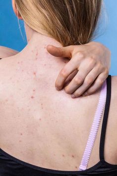 #ColdSoreRemedies Get Rid Of Back Acne, Rid Of Back Acne, Clear Smooth Skin, Coldsore Remedies Quick, Back Acne, Natural Health Care