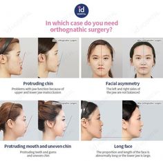 Orthognathic Surgery in Korea, the upper and lower jaws are cut and relocated to fix mastication and speech problems as well as to bring excellent Protruding Chin, Speech Problems, Facial Asymmetry, Bigger Lips Naturally, Double Jaw Surgery, Hospital Website, Plastic Surgery Korea, Orthognathic Surgery, Face Surgery