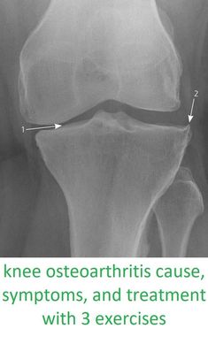 knee osteoarthritis cause, symptoms, and treatment with 3 exercises2 Knee Replacement Surgery Recovery, Aching Knees, Knee Relief, Osteoporosis Exercises