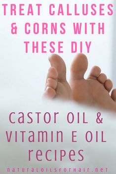 Callus Remover Diy, Corn Removal, Homemade Oil, Callus Removal, Natural Oil, Vitamin E Oil, Oil Recipes