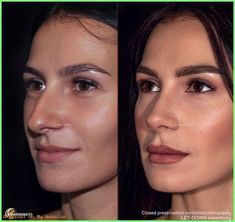 Closed Rhinoplasty, Celebrity Surgery, Lip Surgery, Pointed Nose, Rhinoplasty Surgery, Straight Nose