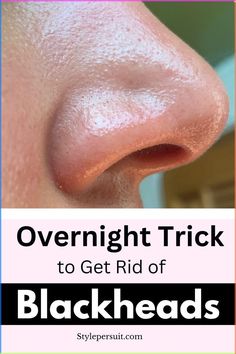 You can easily get rid of these blackheads by using natural or home remedies for blackhead treatment. Click to read How to get rid of blackheads diy| The best blackheads removal on nose| get rid of blackhads on face| get rid of blackheads on nose| how to get rid of blackheads naturally Blackheads Removal Cream, Get Rid Of Pores, Blackheads On Face, Remove Blackheads From Nose, Blackhead Remover Diy, Blackhead Remedies, Nose Pores, Blackheads On Nose, Rid Of Blackheads