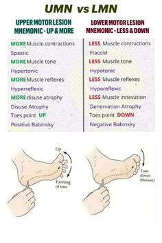 Upper Motor Neuron Vs Lower Motor Neuron, Special Tests Physical Therapy, Neuro Physiotherapy, Upper Motor Neuron, Neurological Examination, Physiotherapy Student, Pt School, Physical Therapy School, Physical Therapy Student