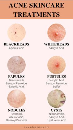 Different Types Of Acne, Acne Patches, Skin Advice, Acne Skincare, Natural Acne Remedies, Types Of Acne, Healthy Skin Tips