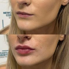 Simple Lip Fillers, Lip Filler Smile Before And After, Lip Flip And Filler Before And After, One Syringe Lip Filler, Lip Filler On Small Mouth, Healed Lip Filler, Volbella Lips Before And After, Lip Injections Before And After 0.5ml