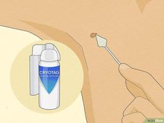 The easiest and most reliable ways to remove pesky skin tags  Have you discovered a soft, flesh-colored flap of skin growing from your neck, armpit, or groin? Skin tags, also known as acrochordons, usually appear on parts of the body where... Remove Skin Tags, Skin Tags, Parts Of The Body, Healthy Advice, 1st Night, Skin Disorders, The Body, Home Remedies, Diet