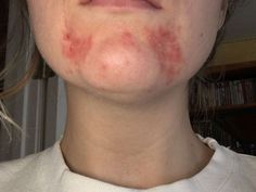 These are the most effective products I used to completely cure Perioral Dermatitis. Facial Rash Remedies, Skin Issues On Face, Contact Dermitis Face, Perioral Dermitis Natural Remedies, Perioral Dermitis Skincare, Dermitis On Face, Perioral Dermitis Causes, Contact Dermitis Rash, Atopic Dermitis Remedy