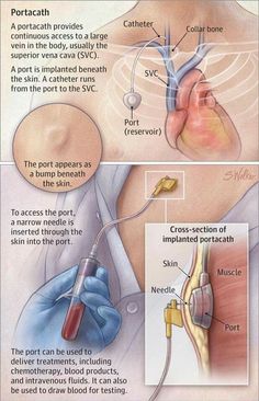 the procedure is being performed to treat and treat for an injured person's heart