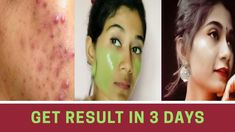 Best Facepack for Glowing skin|Affordable Facepack for Teenagers||Remove acne |Style with RakhiMy Name is Rakhi and ur waching Style with RakhiMy channel is ... Facepack For Glowing Skin, To Remove Pimples, Spotless Skin, Remove Pimples, Blind Pimple, Pimples Under The Skin, Bad Acne, Acne Overnight, Pimples Overnight