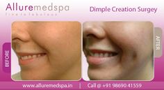 Get natural looking dimples by dimple creation Surgery. We safe and affordable dimple surgery in Mumbai, India. Before And After Pictures, Mumbai, India, Tattoos