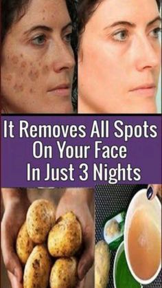 Spots On Forehead, Brown Age Spots, Creme Anti Age, Skin Spots, Spots On Face, Baking Soda Shampoo