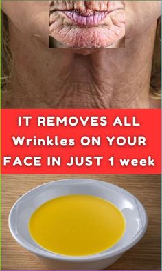 Wrinkle Remedies Face, Eyelid Wrinkles, Natural Wrinkle Remedies, Face Wrinkles Remedies, Wrinkle Prevention, Wrinkles Remedies, Wrinkles Remedies Face, Home Remedies For Wrinkles, Mouth Wrinkles