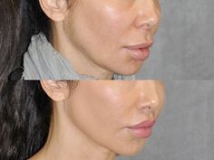 Upper Lip Lift Before And After, Upper Lip Lift, Lip Threading, Lip Plastic Surgery, Neck Lift Surgery