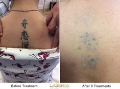 Deep ink on this tattoo but the laser has shown dramatic results. If using a non Picosecond laser, about double the number of treatments would have been required. That’s why it pays to use a Pico laser . Picosure Tattoo Removal, Pico Laser, Laser Hair Reduction, Lighter Hair, Skin Patches, Laser Skin, Skin Redness